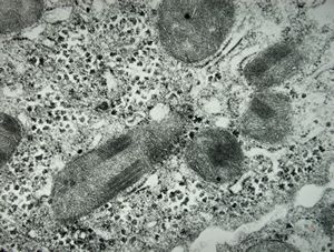 M,15y. | Wilson disease - megamitochondria M,15y. | Wilson disease - megamitochondria
